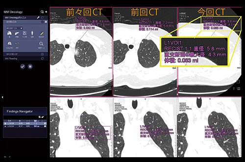 図7　CT Lung CAREを用いた肺結節の経時的評価