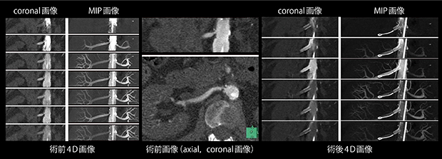 腎動脈における超低造影剤量4次元イメージング
