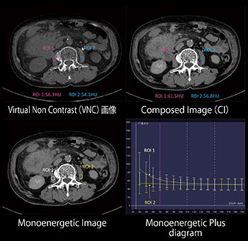 TwinBeam DECTによる腫瘍浸潤評価