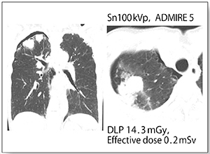 図4　症例4：原発性肺がん疑いで肺生検施行後（60歳，女性）