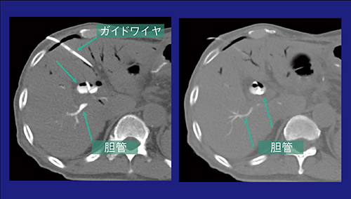 図5　症例2：CT透視下で肝内胆管の穿刺を確認