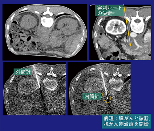 図6　症例3：CT透視下生検