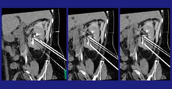 図7　症例4：腎がんの凍結療法 多断面による穿刺針の確認で頭尾方向に長い腫瘍を確実に穿刺