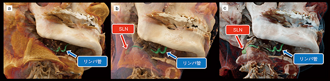 図4　症例提示：Cinematic VRTによる3D-CT画像 a：胸鎖乳突筋より深部に存在するSLNは描出されない。 b：胸鎖乳突筋を透過させてSLNを描出させた。 c：胸鎖乳突筋を削除してSLNとリンパ管を鮮明に描出させた。