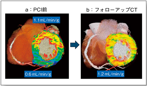 図3　PCI 前後の心筋血流CT によるMBF定量評価
