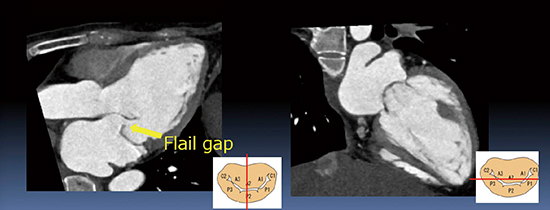 図7　症例4：MitraClip治療のためのflail gapの計測（4DCT画像：MPR）