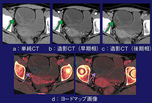 図4　症例4：ヨードマップ画像による卵巣囊胞腺腫の捻転の評価