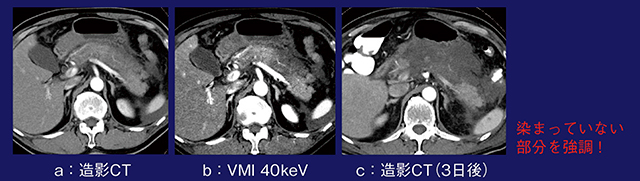 図6　症例6：仮想単色X線画像による急性膵炎の評価