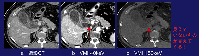 図7　症例7：仮想単色X線画像による胆囊結石の検出