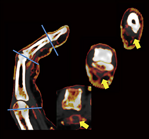 図3　変形が強い関節に対するDECTヨードマップ横断像による評価 79歳，男性。第3指屈筋腱の複数の腱鞘輪状部pulley（↑）に相当して腱鞘炎を認める。