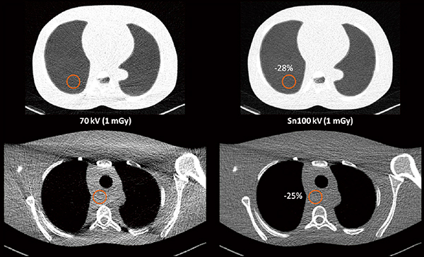 図3　Sn100kVによる肺の超低線量CT（1mGy）のファントム画像