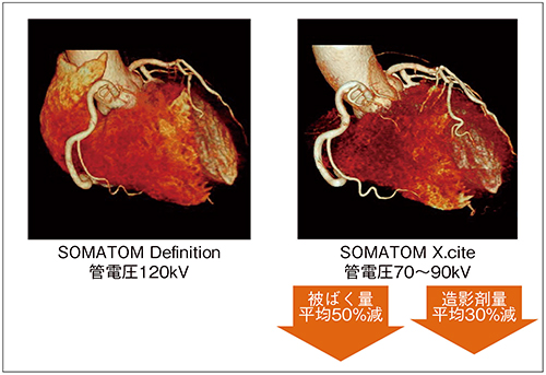 図3　SOMATOM X.citeによる低管電圧撮影（心臓CT）