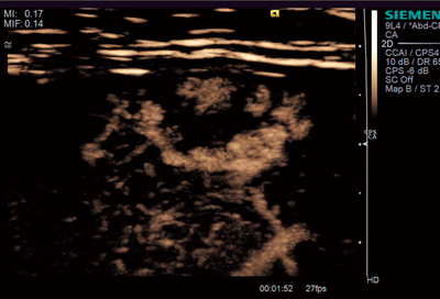 図3　CPSによる造影エコーの例 肝表面直下の血管腫。高周波リニアプローブ＋Capture機能により，明瞭に血管構造を描出。（画像ご提供：兵庫医科大学･飯島尋子先生）