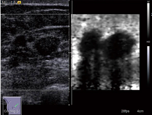 図1　Virtual Touch Imaging（非浸潤性乳管癌）（画像ご提供：りんくう総合医療センター外科・位藤俊一先生）