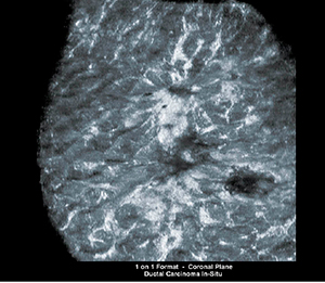 図2　ABVSによる冠状断面の描出（非浸潤性乳管癌）