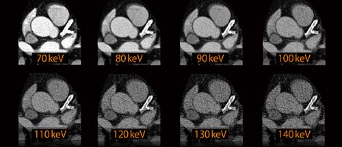 図2　DE Monoenergeticによる冠動脈のステント内腔評価