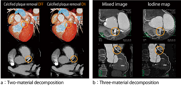 図3　DEイメージングによる物質弁別を利用した冠動脈の石灰化除去