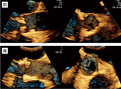 図3　大動脈弁狭窄の長軸・短軸の3D TEE画像