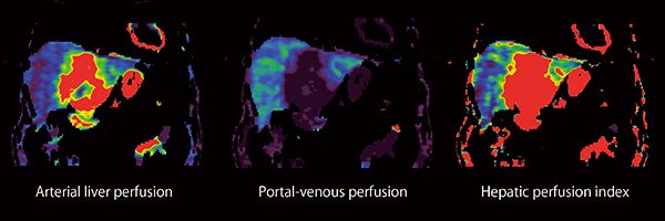 図1　標的療法前の全肝パーフュージョン検査の一例（画像ご提供：ドイツ・UMM様）