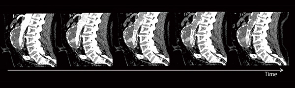 図2　腎機能が低下した患者における腹部大動脈瘤ステントグラフト内挿術後のエンドリーク評価例（画像ご提供：ドイツ・UMM様）
