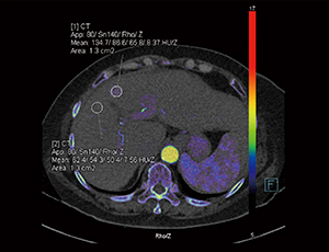 図2　syngo.CT DE Rho/Zによる電子密度と実効原子番号の測定（画像ご提供：Universitätsklinikum Erlangen, Radiology Department）