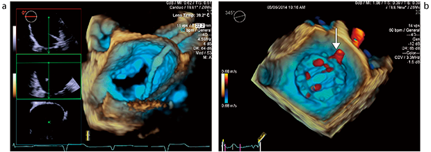 図3　心臓全体のリアルタイム3D TEE画像