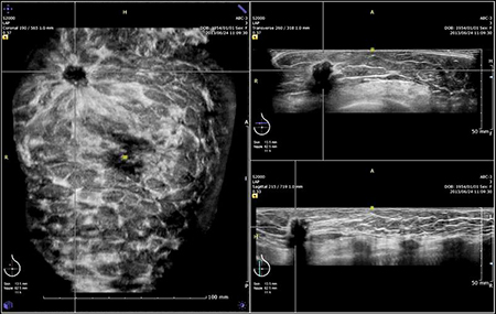 図2　硬癌 冠状断面にて左A領域にスピキュラを認める。