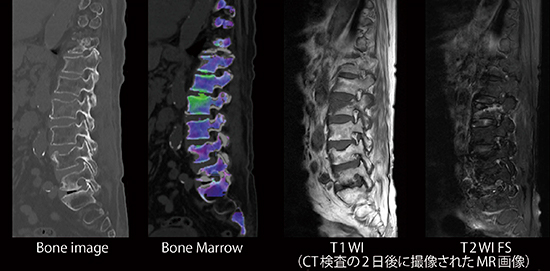図2　DE Bone Marrowによる骨折の新旧鑑別 椎体圧迫骨折診断において，新鮮骨折および陳急性骨折が混在している場合には，形態評価のみでは診断，鑑別に苦慮する。受傷日に撮影したDE Bone Marrowでは，受傷2日後のMRI T1WI 低信号，T2WI 高信号領域に一致した部位に浮腫が認められていることがわかる。 （画像ご提供：天草地域医療センター様）