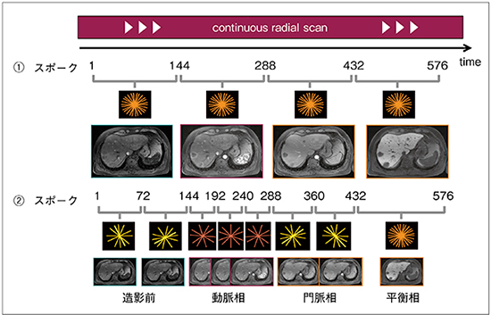 図3　Continuous radial scanからの画像再構成 (1) 従来法と同様の時相のデータを得る。 (2) 動脈相だけ時間分解能を上げた画像を作成することが可能。