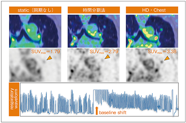 図2　70歳代，女性，肺がん患者 PET撮像中に呼吸波形のbaseline shiftが見られる例での呼吸同期法の比較 （画像ご提供：九州大学病院様）