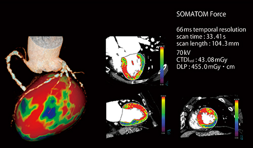 図3　ダイナミック負荷心筋パーフュージョンCT検査 Dual Source CTでは撮影心位相を収縮末期とすることができるため，心拍変動や不整脈による形態変化の影響を受けにくく，心筋の内膜側と外膜側の血流差を評価しやすい。 （画像ご提供：中国・Peking University Medical College）