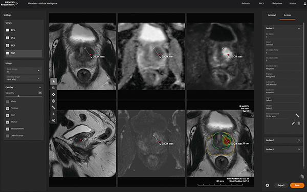 図2　マルチパラメトリックMRI画像に対するAI画像診断支援ソフトウエアの解析結果例 赤いランドマーク，あるいは右下の画像のヒートマップが病変部を示す。