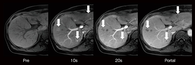 図5　CAIPIRINHA VIBE 応用例（造影ダイナミック） 全肝臓ダイナミックの撮像時間を10秒以内に設定し，動脈相を2フェーズ撮像した例。造影後20秒では肝実質と等信号の肝細胞がん（HCC：↓）が，10秒相では確認できる。