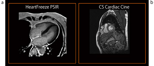 図5　自由呼吸下の心臓MRI a：HeartFreezeによる自由呼吸下PSIR b：CS Cardiac Cineによるリアルタイムシネ撮像