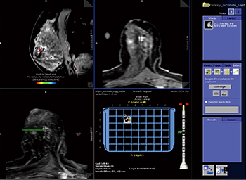 図3　syngo BreVis Biopsy操作画面