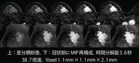 図2　GRASPによるBreast DCE MRI