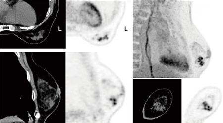 図1　左乳房BD領域に多発する小腫瘤の明瞭な描出 「伏臥位用乳房撮像クッションCPM」（中部メディカル社製）を使用し，腹臥位で撮像，TOF＋PSF，880×880マトリックスの高分解能画像再構成を実施 （画像ご提供：九州大学病院様）