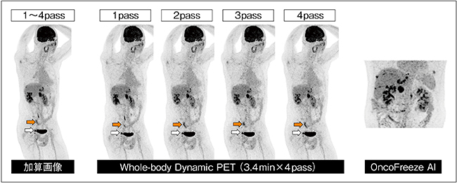 図1　WBD PETとOncoFreeze AIの活用例