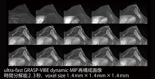 図1　GRASP-VIBEによるultra-fast DCE MRIの画像例