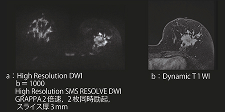 図2　SMS RESOLVEの画像例 High resolution DWI画像（a）と，同じslice位置のDynamic T1WI（b）