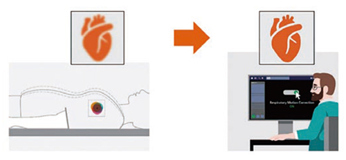図1　デバイスレスで呼吸体動を補正する機能rMC Pro