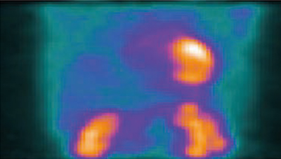 図3　82Rb検査における1秒間のhist-image （画像ご提供：Dr. Ian Armstrong, Central Manchester University Hospitals, Manchester, UK.）