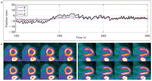 図4　82Rb検査における非周期的動きの測定例 a：動きの測定 b：非周期的な動きによるボケが生じているが（上段），Cardio Directによる補正によって明瞭に描出されている（下段）。 （画像ご提供：Dr. Ian Armstrong, Central Manchester University Hospitals, Manchester, UK.）