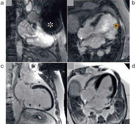 図3　High Bandwidth Inversion Recovery LGE a，b：従来のLGE シーケンス c，d：High Bandwidth Inversion Recovery LGE シーケンス 磁化率アーチファクトによる信号欠損（＊），異常信号（＊）が低減できている。 （参考文献7）より引用転載）
