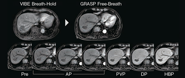 図2　GRASPを用いた肝臓ダイナミック撮像 GRASPを使用することで，自由呼吸下にてモーションアーチファクトのない動脈相が得られている。 （画像ご提供：大阪府済生会吹田病院様）
