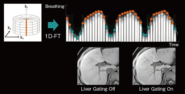図3　Self-Navigationを用いた呼吸同期機能（Liver Gating） kz方向のプロジェクションデータを1D-FTし，呼気時相のみを使用した画像再構成を行う。