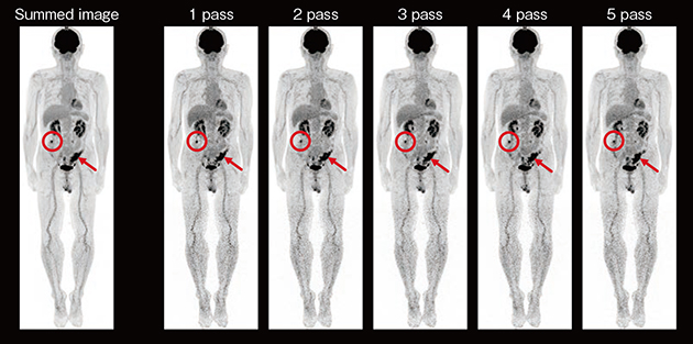 図1　大腸がん患者におけるWBD PETの活用 S状結腸に閉塞性病変（↑）があり，内視鏡では口側の確認ができなかったが，WBD PETにより上行結腸の病変（○）が確認できた症例である。 （画像ご提供：市立青梅総合医療センター様）