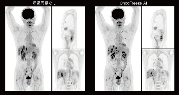 図2　撮像時間の延長が不要なPET呼吸同期技術 OncoFreeze AIの活用 （画像ご提供：大阪公立大学医学部附属病院様）