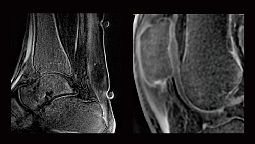 MRIでは描出が難しかった靭帯や腱の描出 UTE sequence