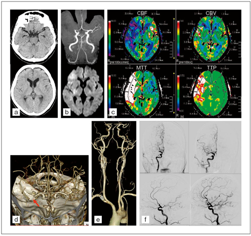 図6　急性期脳梗塞における3D-CT Angiography + CT Perfusion